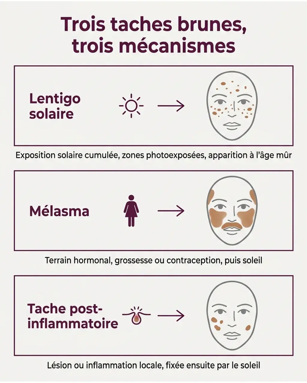 Lentigo solaire, mélasma et tache post-inflammatoire : trois répartitions différentes sur le visage